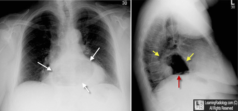 HERNIA DIAFRAGMATIKA Radiologi Id   HiatalHerniax2 