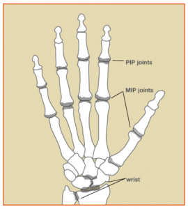 rheumatoid arthritis ízületi röntgenképe)